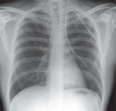 Chest X-ray depicting abnormal position left internal j | Open-i