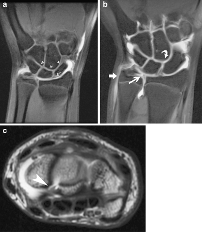 Ligamentous injury. a Normal triangular appearance of t | Open-i