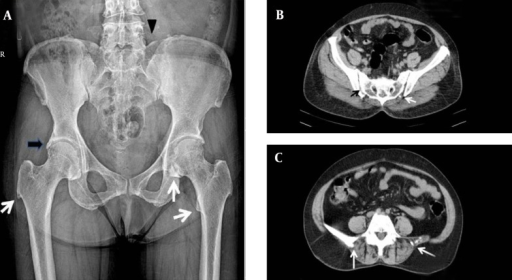 Imaging Studies of PelvisA, (Left) Anteroposterior radi | Open-i