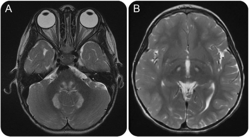 Brain MRI of our patientsAxial T2 image showing hyperintense lesions ...