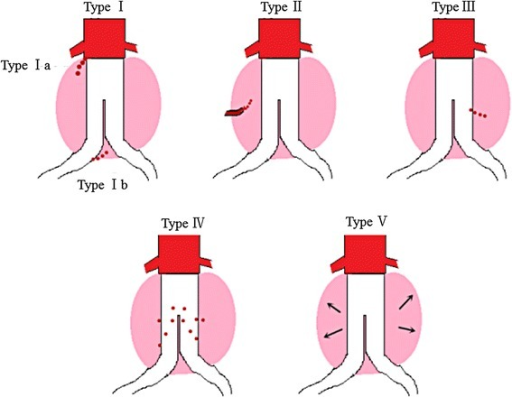 Five types of endoleaks