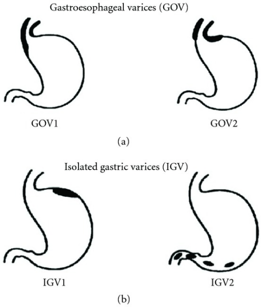 Sarin classification of gastric varices. | Open-i