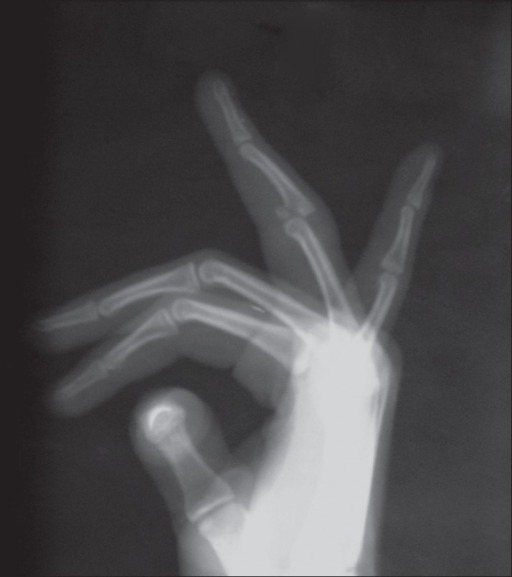 Dorsal Fracture Dislocation Pipj Of Ring Finger Open I