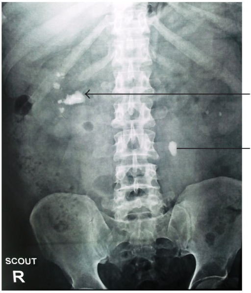 Plain X-ray KUB showing right renal pelvic calculus wit | Open-i