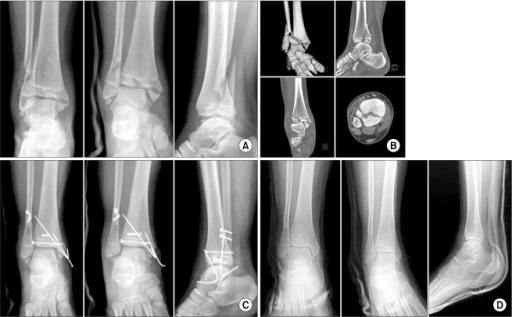Fourteen-year-old girl suffered from a physeal injury t ...