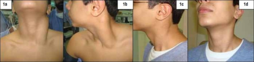 Diffuse enlargement of left sternocleidomastoid muscle | Open-i