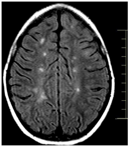 Brain MRI showing multiple juxtacortical lesions. | Open-i