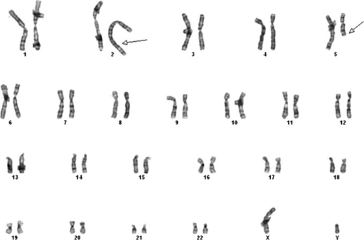 Karyotype 46xy T25q33q13 9 46xy 11 Open I 