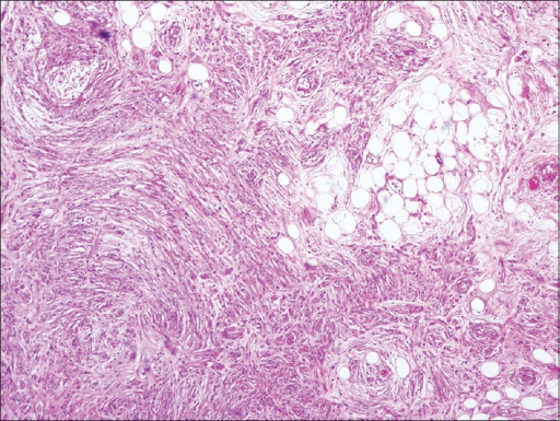 Enlarged nerve bundles infiltrated by fibroadipose tiss | Open-i