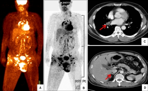 Pet Scan Lymph Nodes