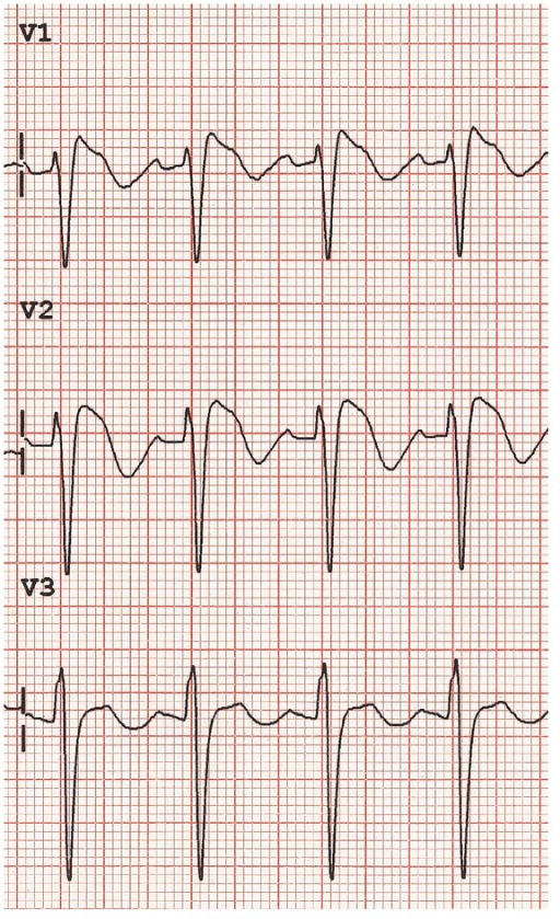 Brugada-like ECG changes that may be seen in propofol i | Open-i