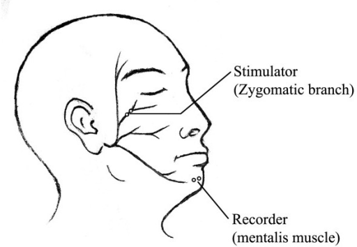 Image Result For Facial Nerve Schematic