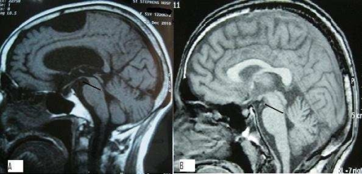 a-sagittal-section-of-brain-mri-in-a-psp-patient-showi-open-i