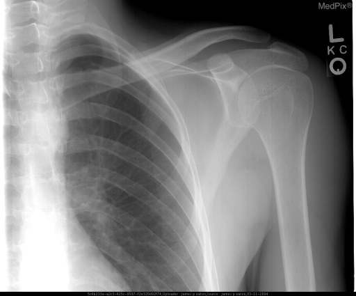 AP shoulder radiograph demonstrates a pleural line with | Open-i