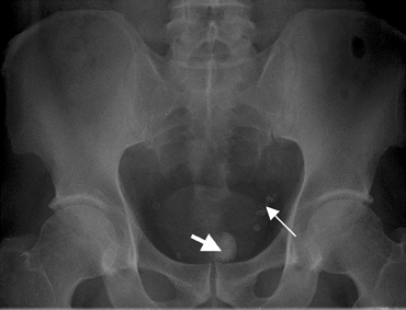 X-ray photo showing the rectal calculus projecting in t | Open-i