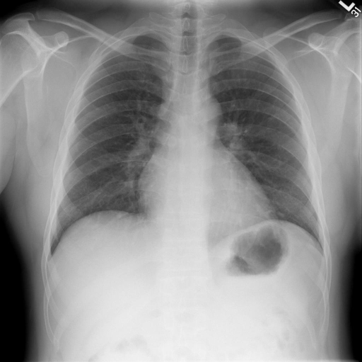 PA and Lateral Chest | Open-i