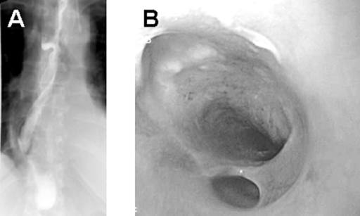 (A) An esophagogram indicating mucosal irregularities a | Open-i