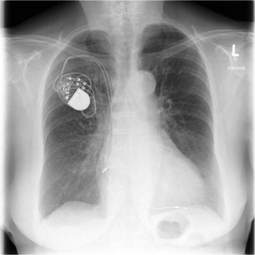 Chest X-ray after pacemaker implantation. | Open-i