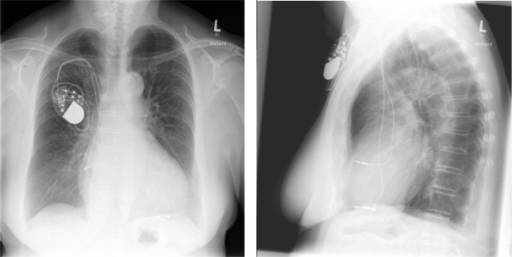 A) Three-month follow-up chest X-ray; B) three-month fo | Open-i