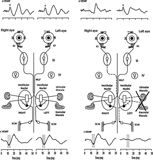 Recordings of cVEMPs (lower traces) and oVEMPs (upper t | Open-i