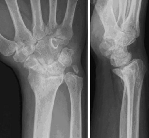 Posteroanterior and lateral x-ray of a patient with rad | Open-i