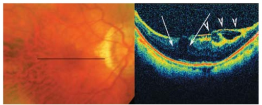 Color Fundus Photographs Of A High Myopic Patient With Mild Foveoschisis The Longitudinal B Color Fundus Photographs Of A High Myopic Patient With Mild Foveoschisis The Longitudinal B