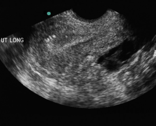 Sagittal view of the uterus on trans-vaginal ultrasound | Open-i