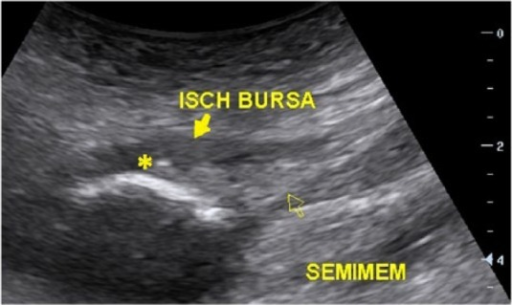 Ischial Tuberosity Bursitis