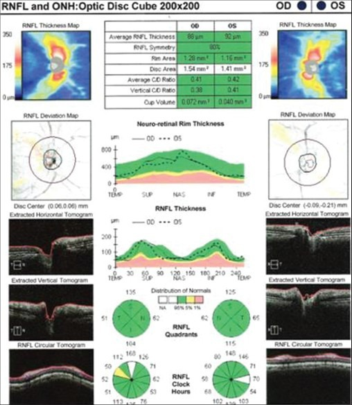 optical coherence tomography for sale
