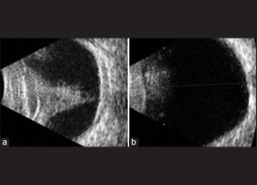 Ultrasonography B scan showing closed funnel retinal de Open i