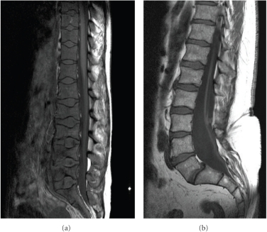 (a) shows a T1W sagittal MRI spine of a patient with si | Open-i