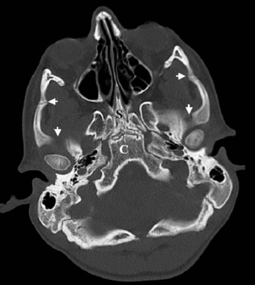 Axial 3DCT scan of the skull base showed osteolytic des | Open-i