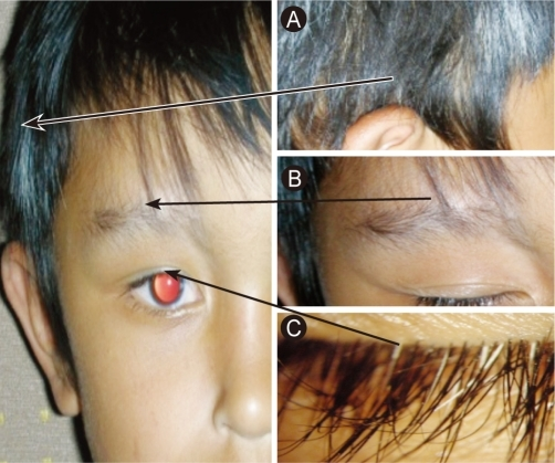 Poliosis on (A) right temporal, (B) the eyebrow, and (C | Open-i