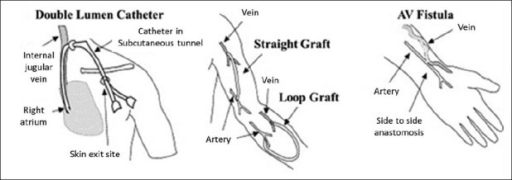 Different Types Of Dialysis Catheters