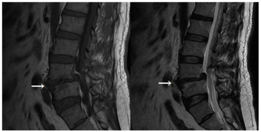 Modic type I changes (indicated by arrow) appear hypoin | Open-i