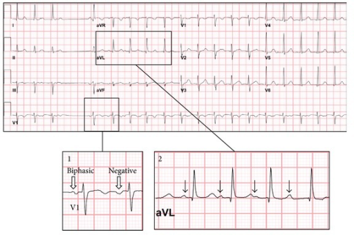 Initial ECG obtained in the pediatric ICU. Ectopic atri | Open-i