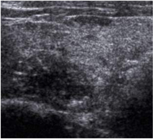 Ultrasound features: Micro-calcification - histology pr | Open-i