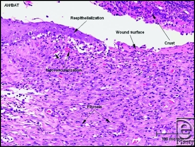 Granulation tissue with prominent neovascularization an | Open-i