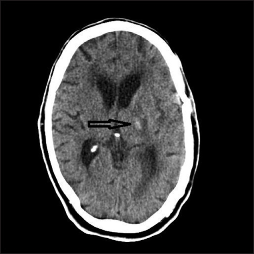 Plain axial CT scan, showed left thalamic hemorrhage wi | Open-i