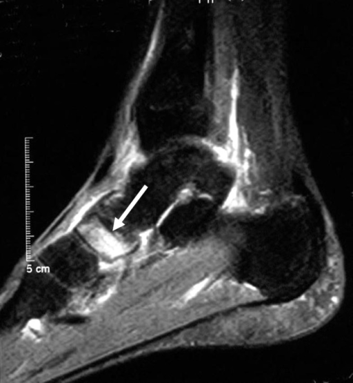 Sagittal MRI of a foot demonstrates a navicular stress