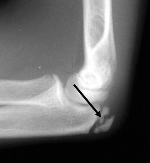 Lateral radiograph of an elbow in a 12-year-old gymnast | Open-i
