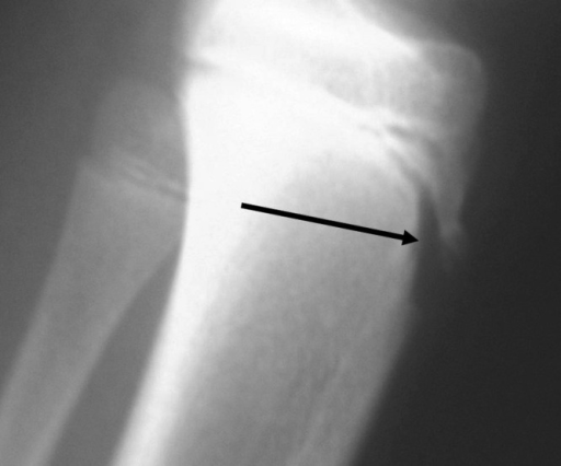 Lateral radiograph of the proximal tibia in a 14-year-o | Open-i