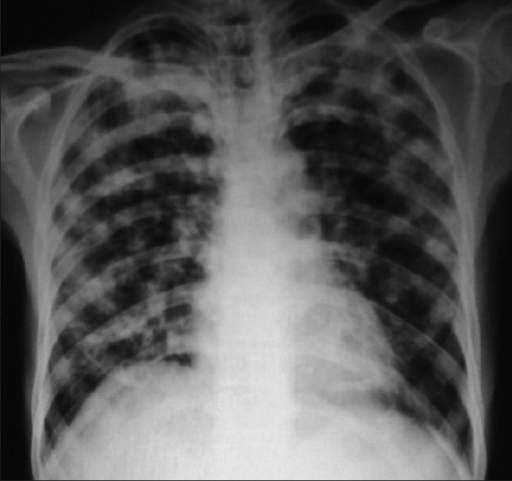 Diffuse nodular infiltration in HIV-TB coinfection | Open-i