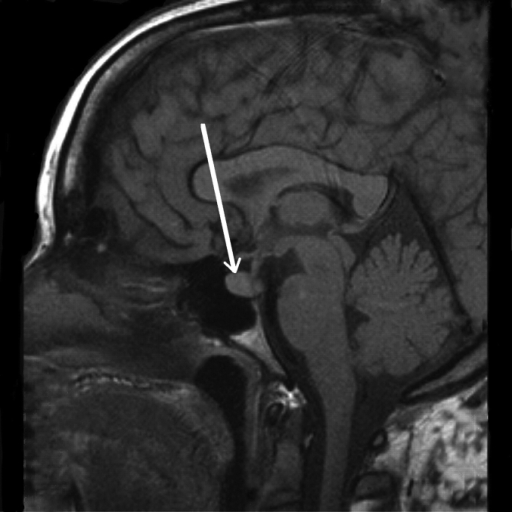 Magnetic Resonance Imaging (MRI) of the brain revealed | Open-i