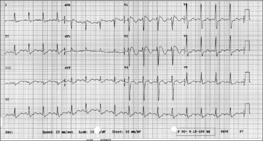 Typical ECG findings in Brugada syndrome | Open-i