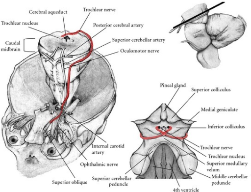 Pathway Of The Trochlear Nerve Elevation And Enlargeme Open I 2514