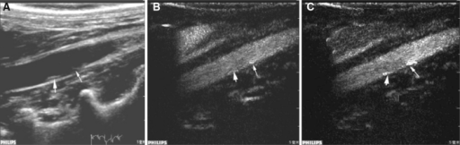 Representative ultrasound images of the atherosclerotic | Open-i