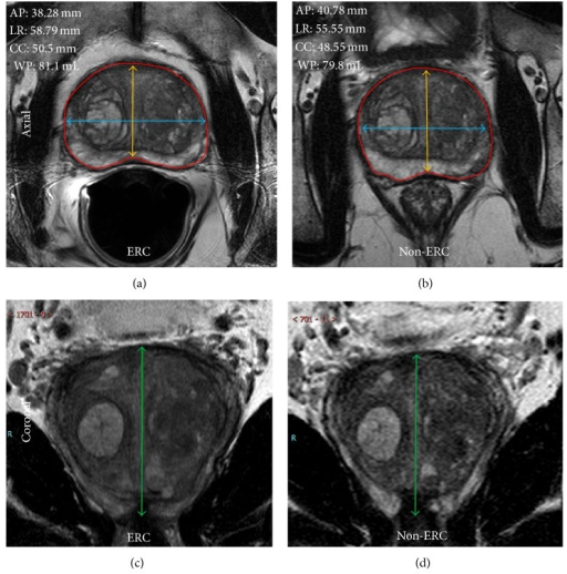 Axial ERC and non-ERC T2W MRI depicting the maximum AP (yellow) and LR ...