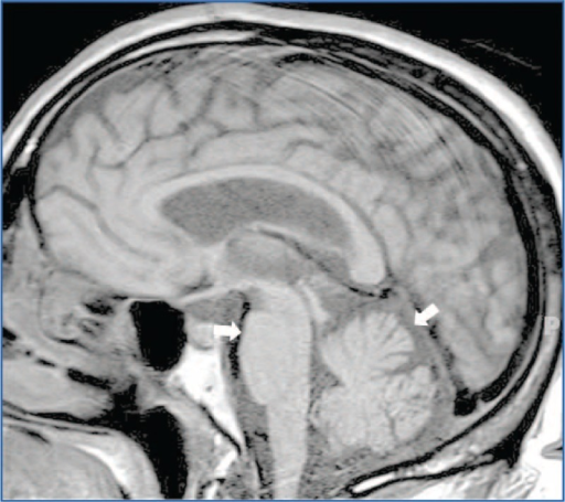 MRI findings in a patient with Multiple System Atrophy | Open-i