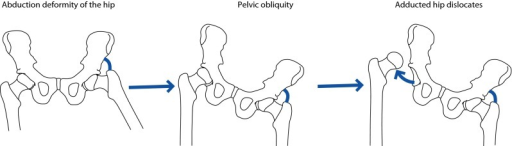 Hip Flexion Contracture Definition Sharon Karam